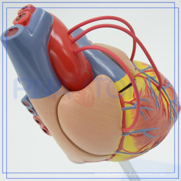 PNT-0400a Venda quente Atherosclerosis Plástico Coração Humano Modelo